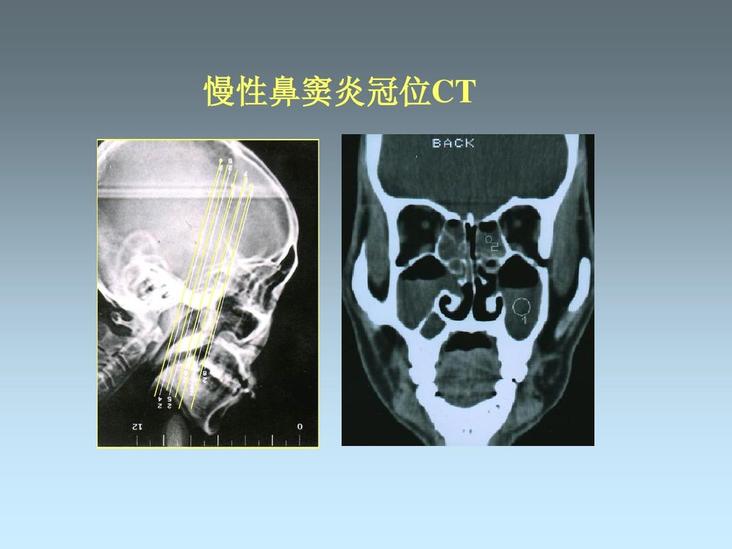 慢性鼻竇炎