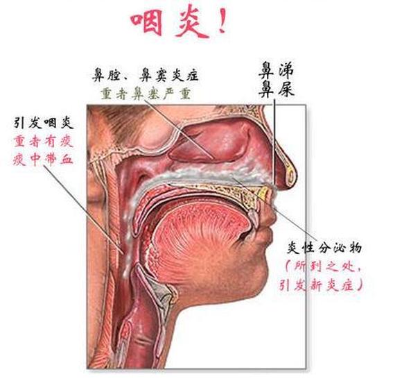 咽炎