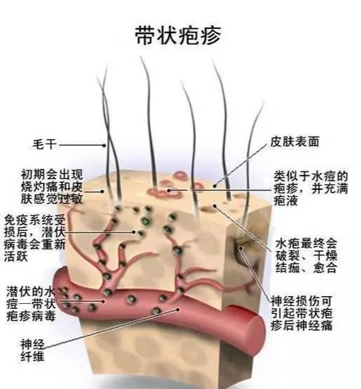 帶狀皰疹