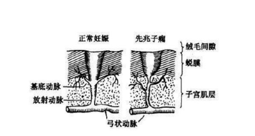 子癇