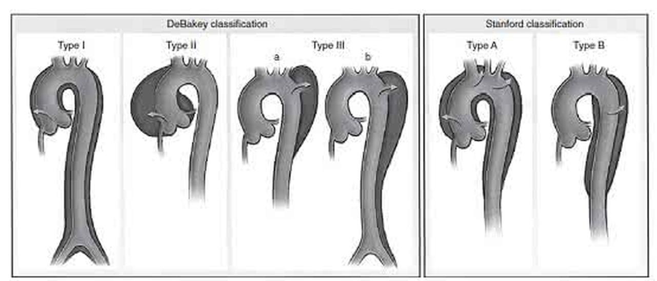 DeBakey分型
