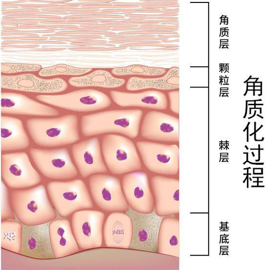 角質(zhì)化