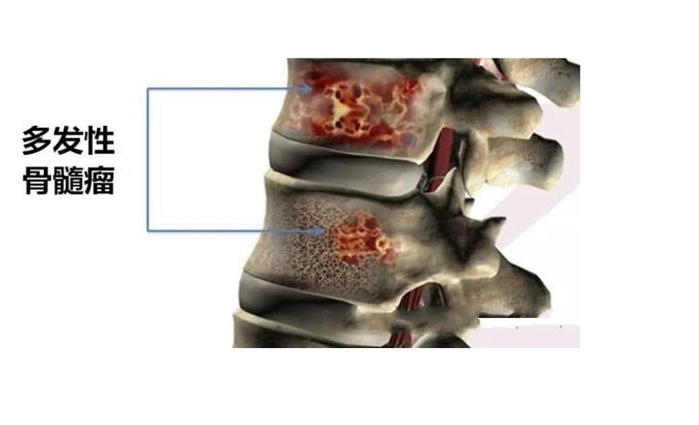 多發(fā)性骨髓瘤