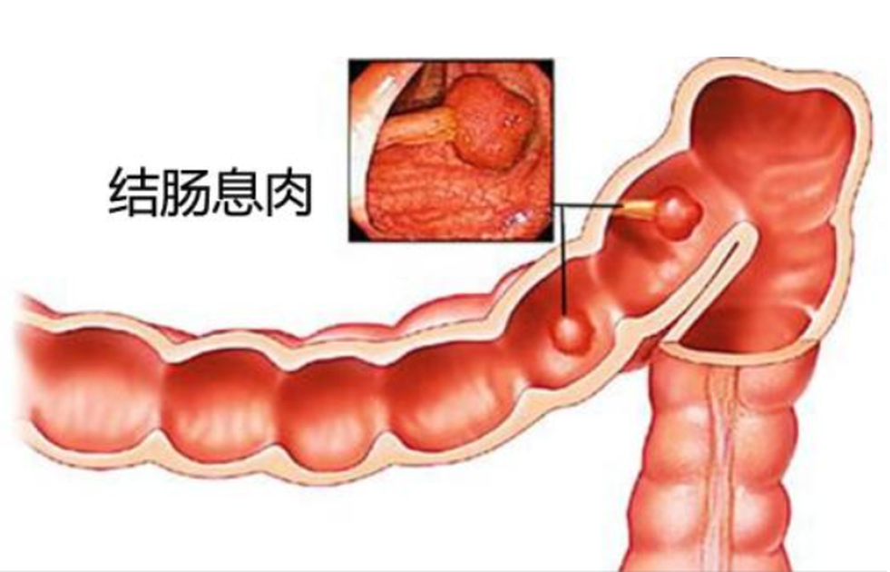 結(jié)腸息肉