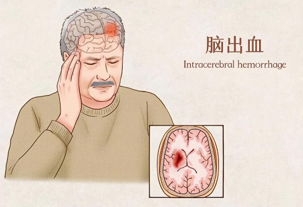 脑出血
