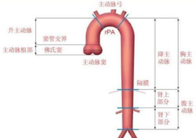 主動脈夾層