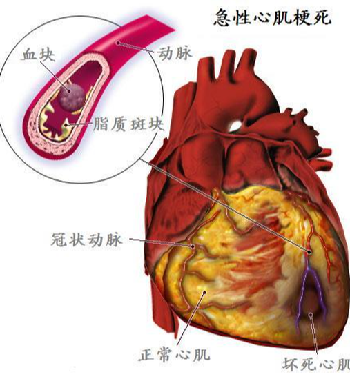 急性心肌梗死