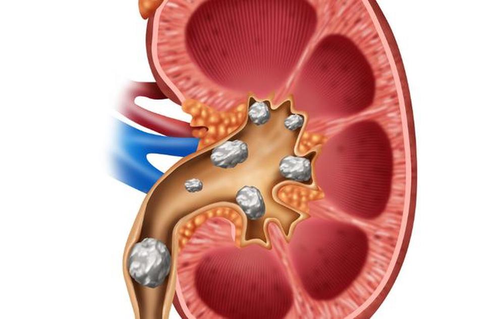 腎結(jié)石