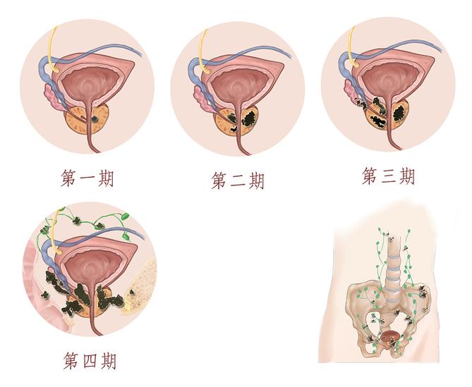 前列腺癌