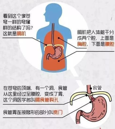 食管裂孔疝