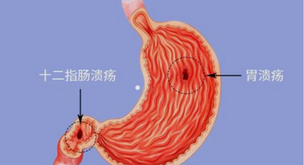 十二指腸潰瘍