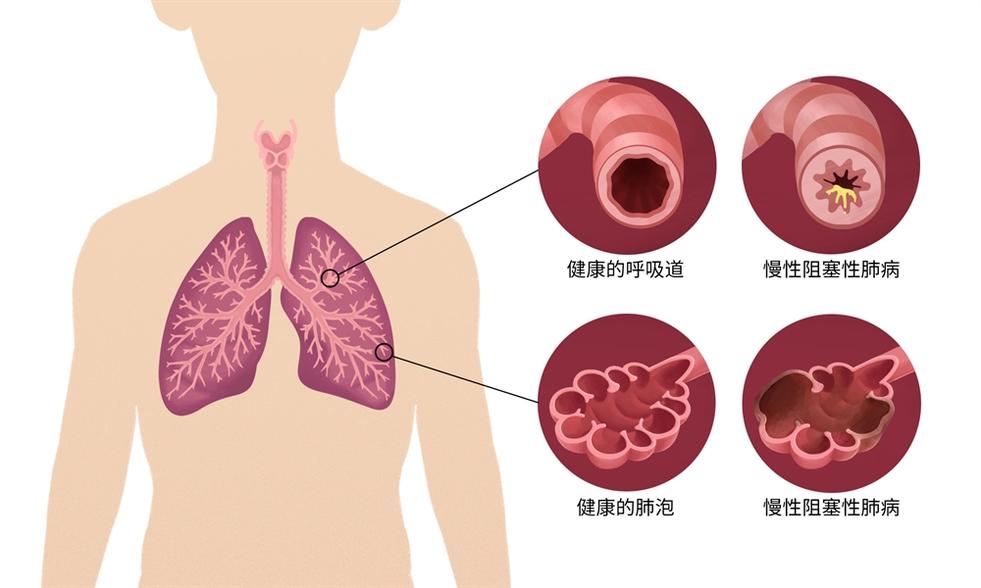 慢性阻塞性肺疾病